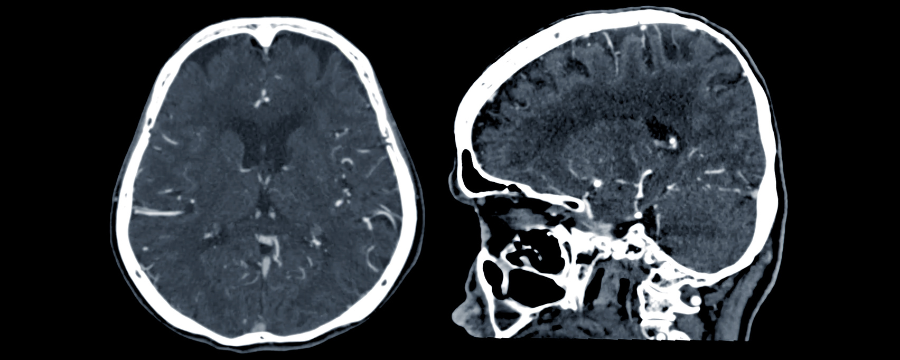 ¿Qué es Tomografía Axial Computarizada Cerebral?